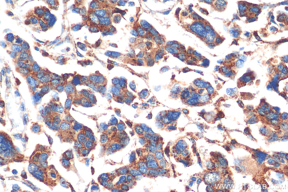 IHC staining of human colon cancer using 27538-1-AP