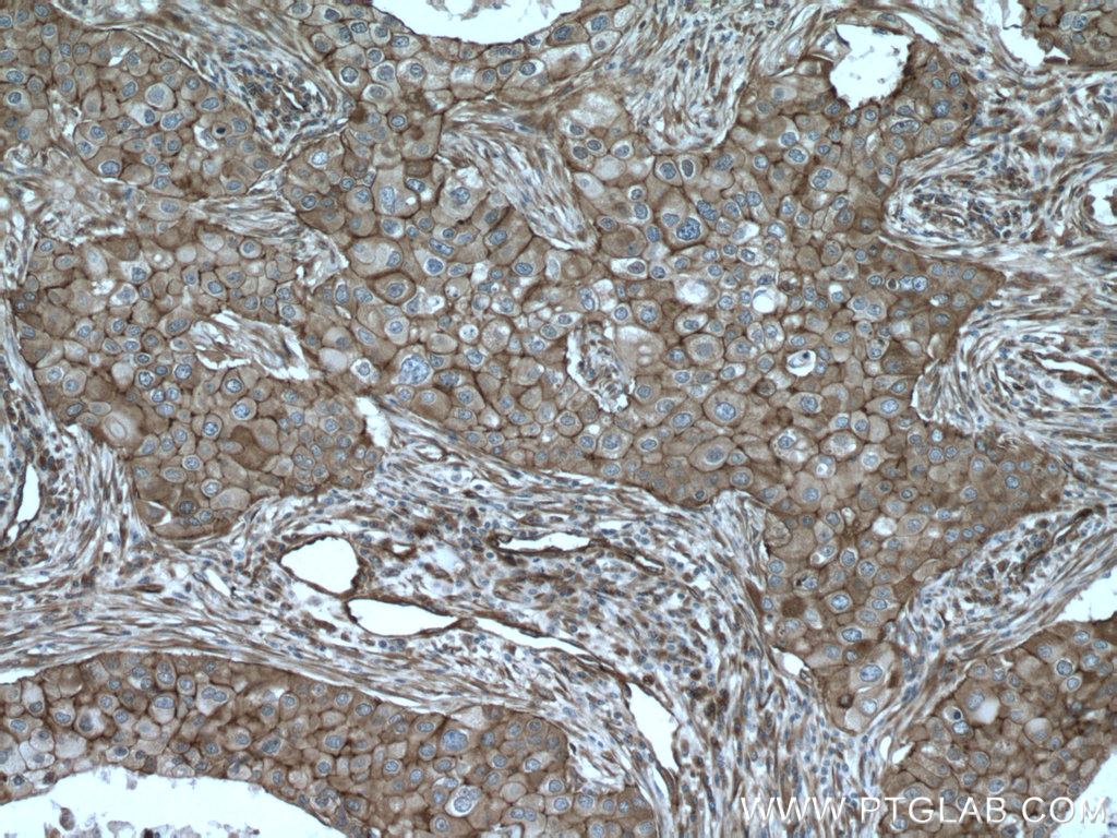 IHC staining of human breast cancer using 11381-1-AP