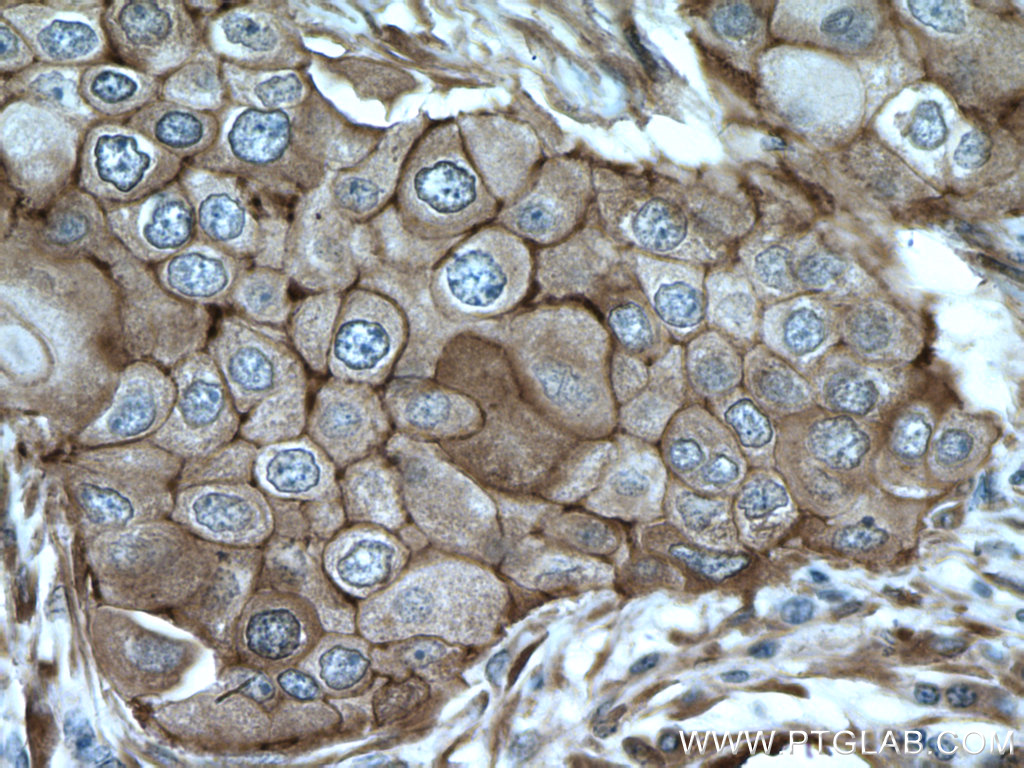 IHC staining of human breast cancer using 11381-1-AP