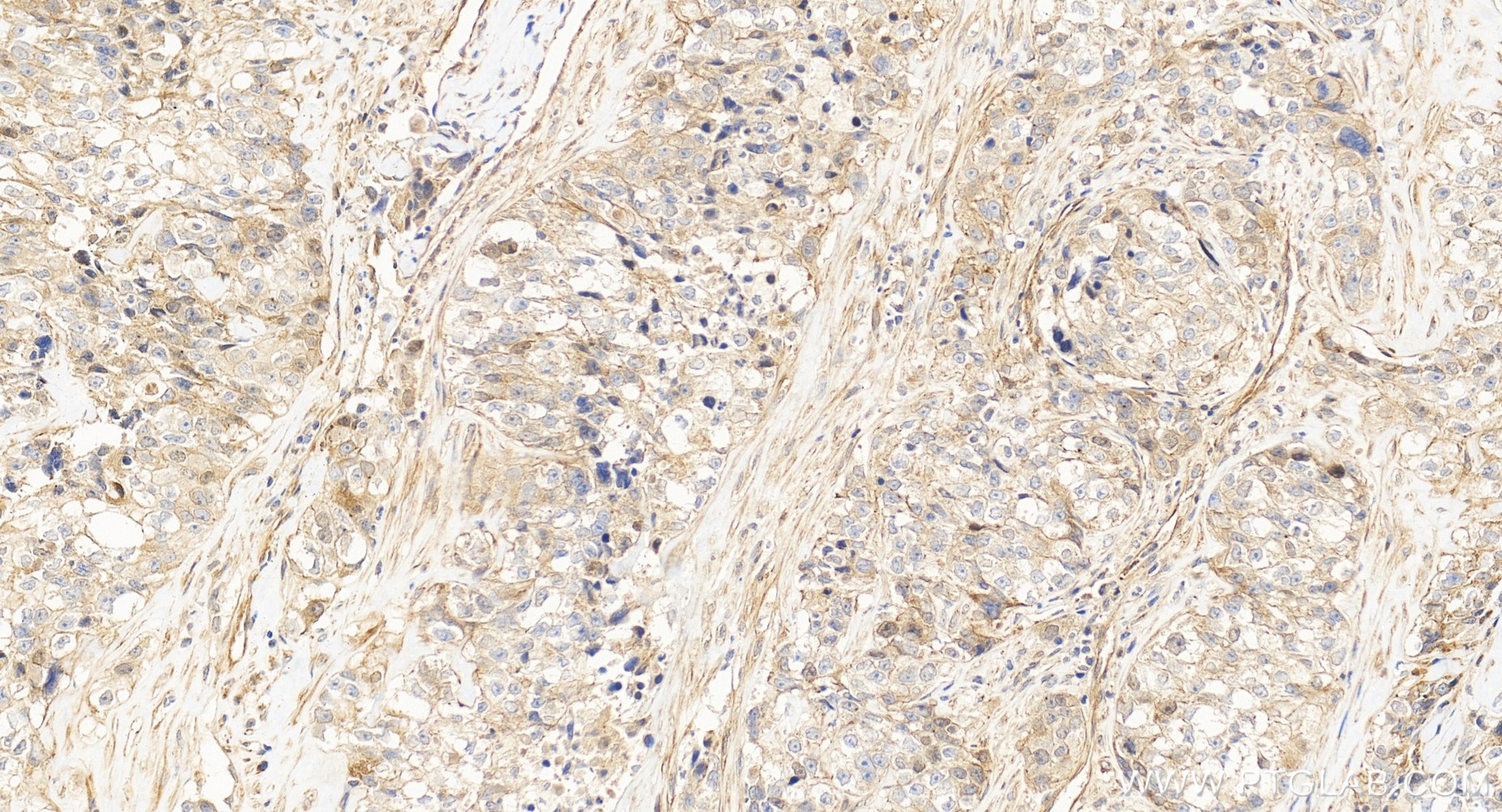 IHC staining of human ovary cancer using 86610-2-RR