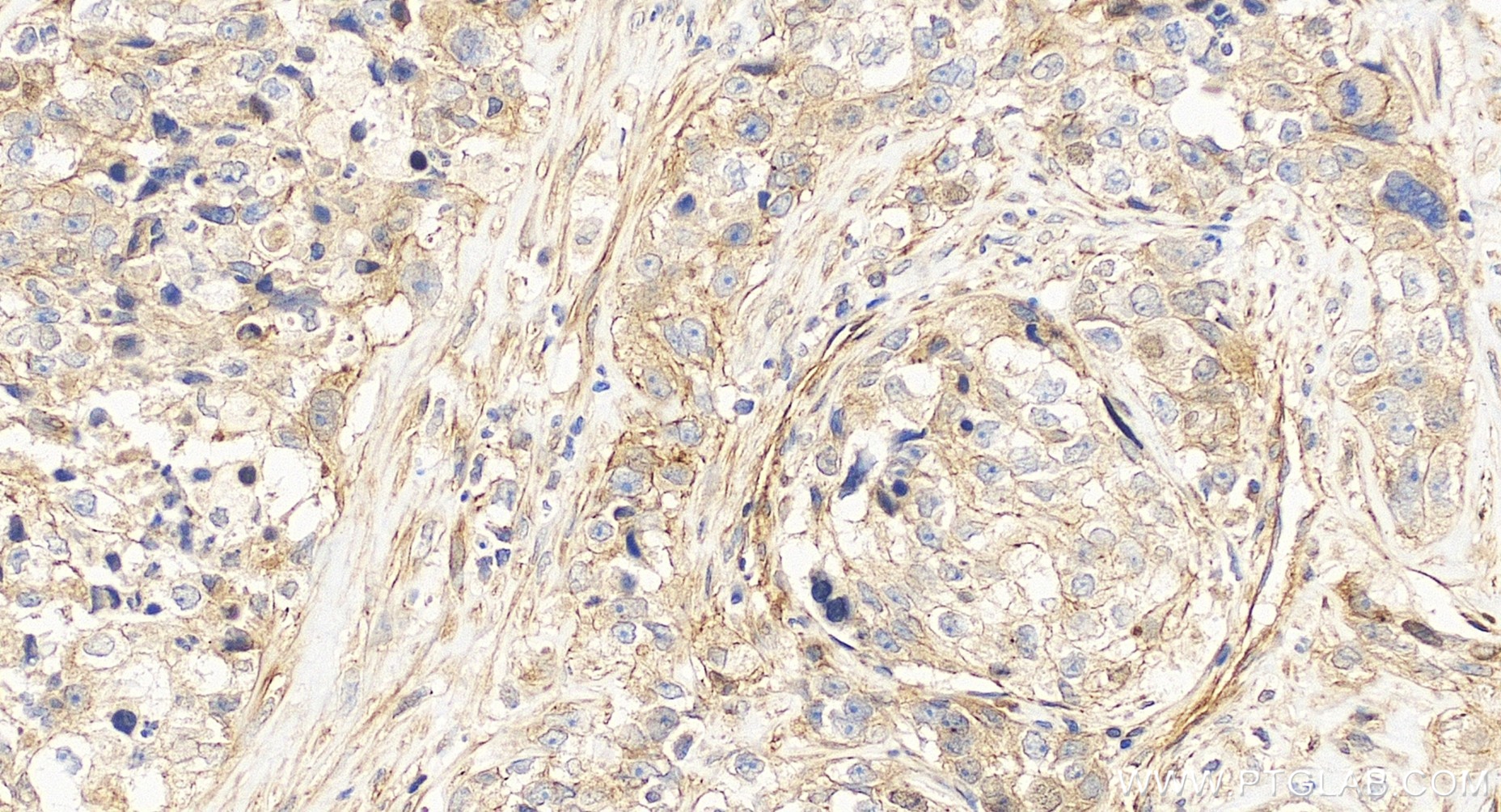 IHC staining of human ovary cancer using 86610-2-RR