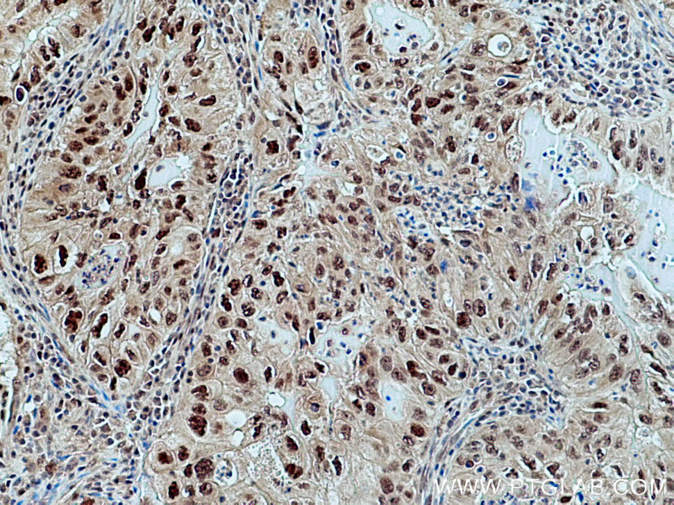 IHC staining of human lung cancer using 12895-1-AP