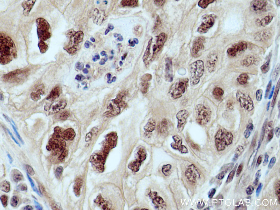 IHC staining of human lung cancer using 12895-1-AP