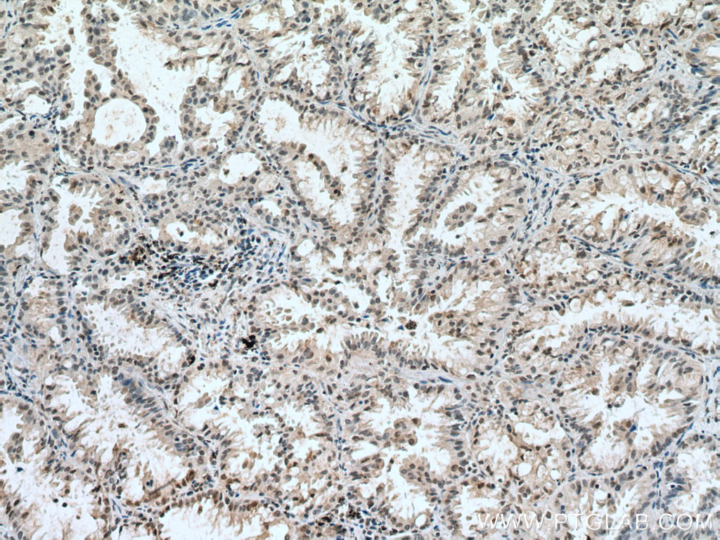 IHC staining of human lung cancer using 66978-1-Ig (same clone as 66978-1-PBS)