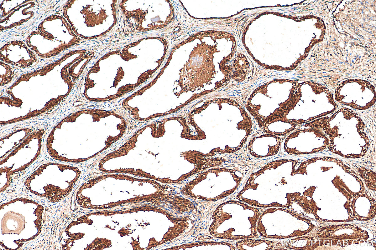 IHC staining of human prostate cancer using 10981-2-AP