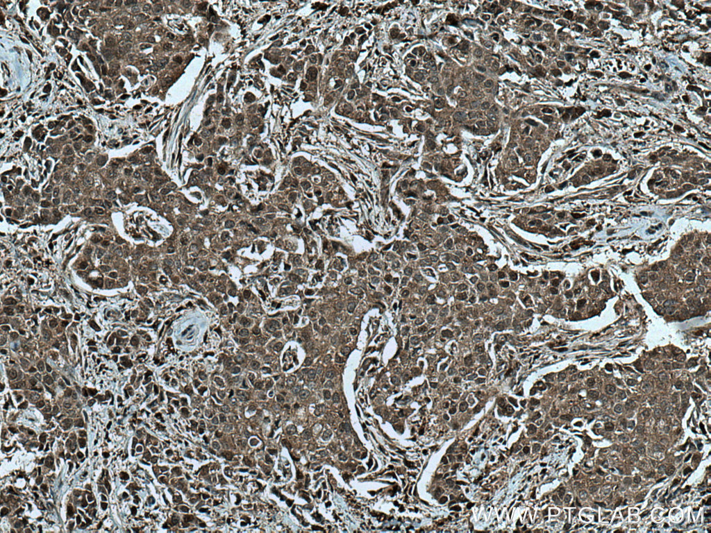 IHC staining of human breast cancer using 67175-1-Ig