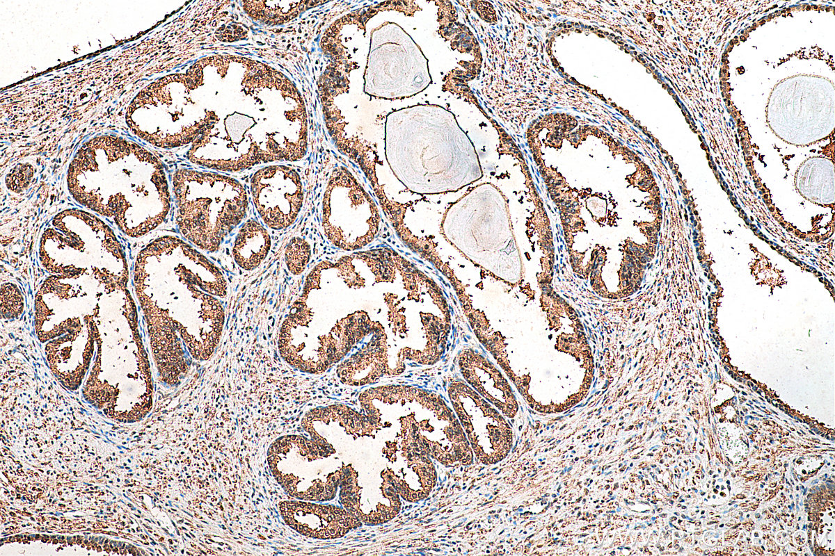 IHC staining of human prostate cancer using 28087-1-AP