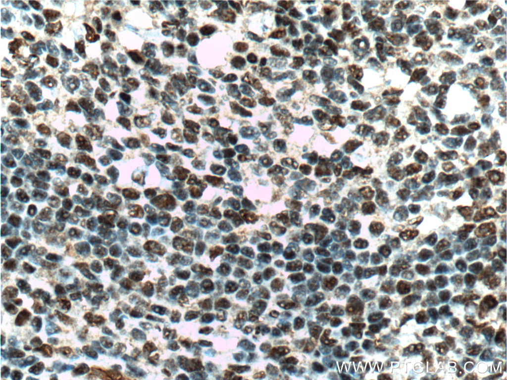 IHC staining of human tonsillitis using 20882-1-AP