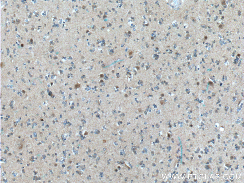 IHC staining of human gliomas using 60151-1-Ig (same clone as 60151-1-PBS)