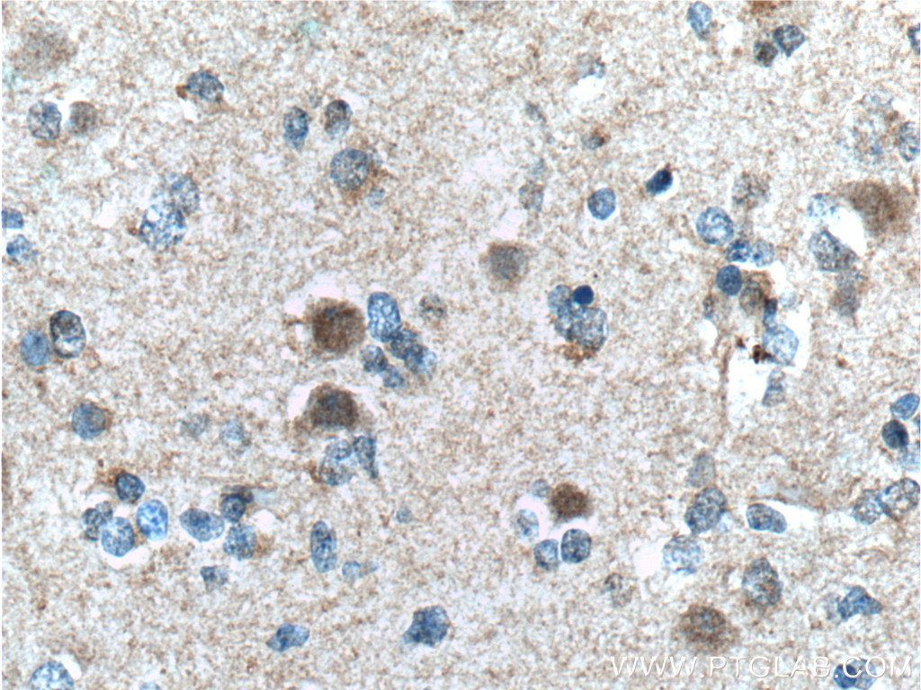 IHC staining of human gliomas using 60151-1-Ig (same clone as 60151-1-PBS)
