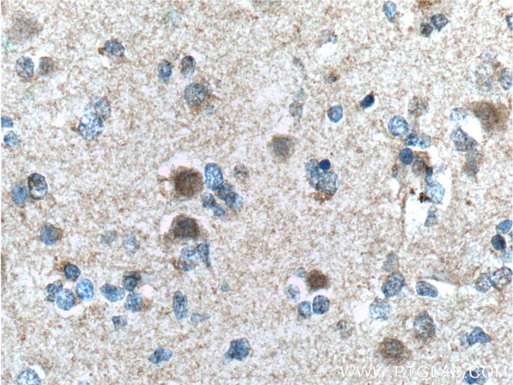 IHC staining of human gliomas using 60151-1-Ig