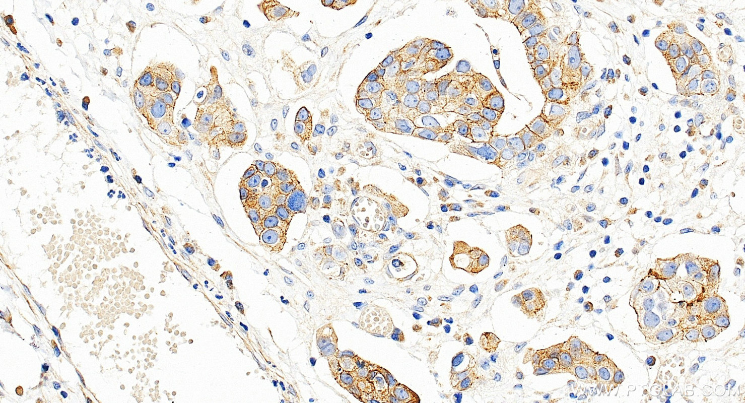 IHC staining of human ovary cancer using 11777-1-AP