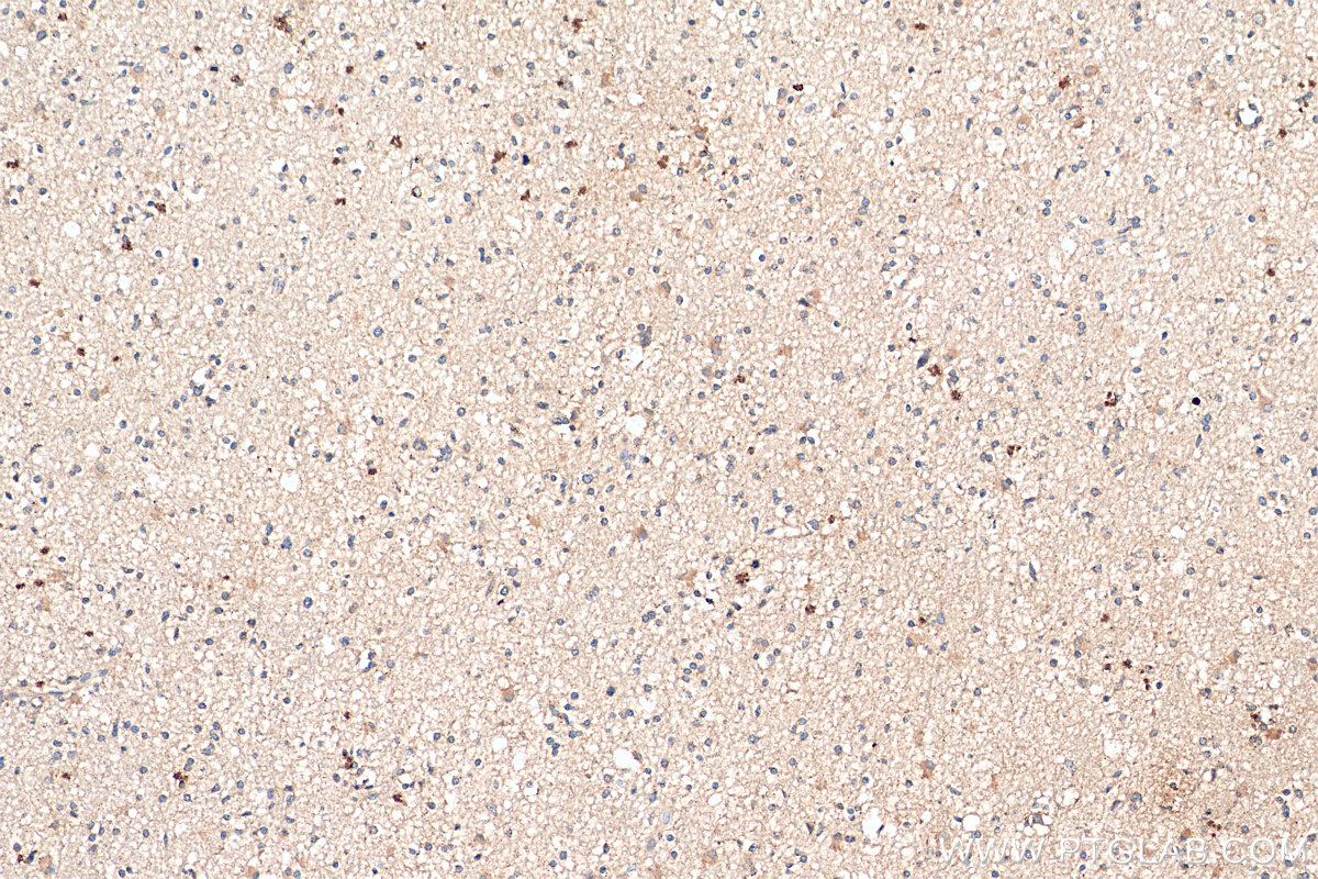 IHC staining of human gliomas using 12335-1-AP