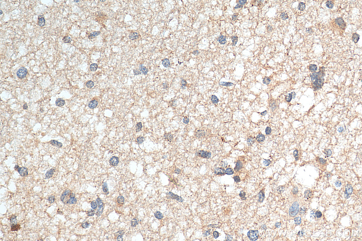 IHC staining of human gliomas using 12335-1-AP