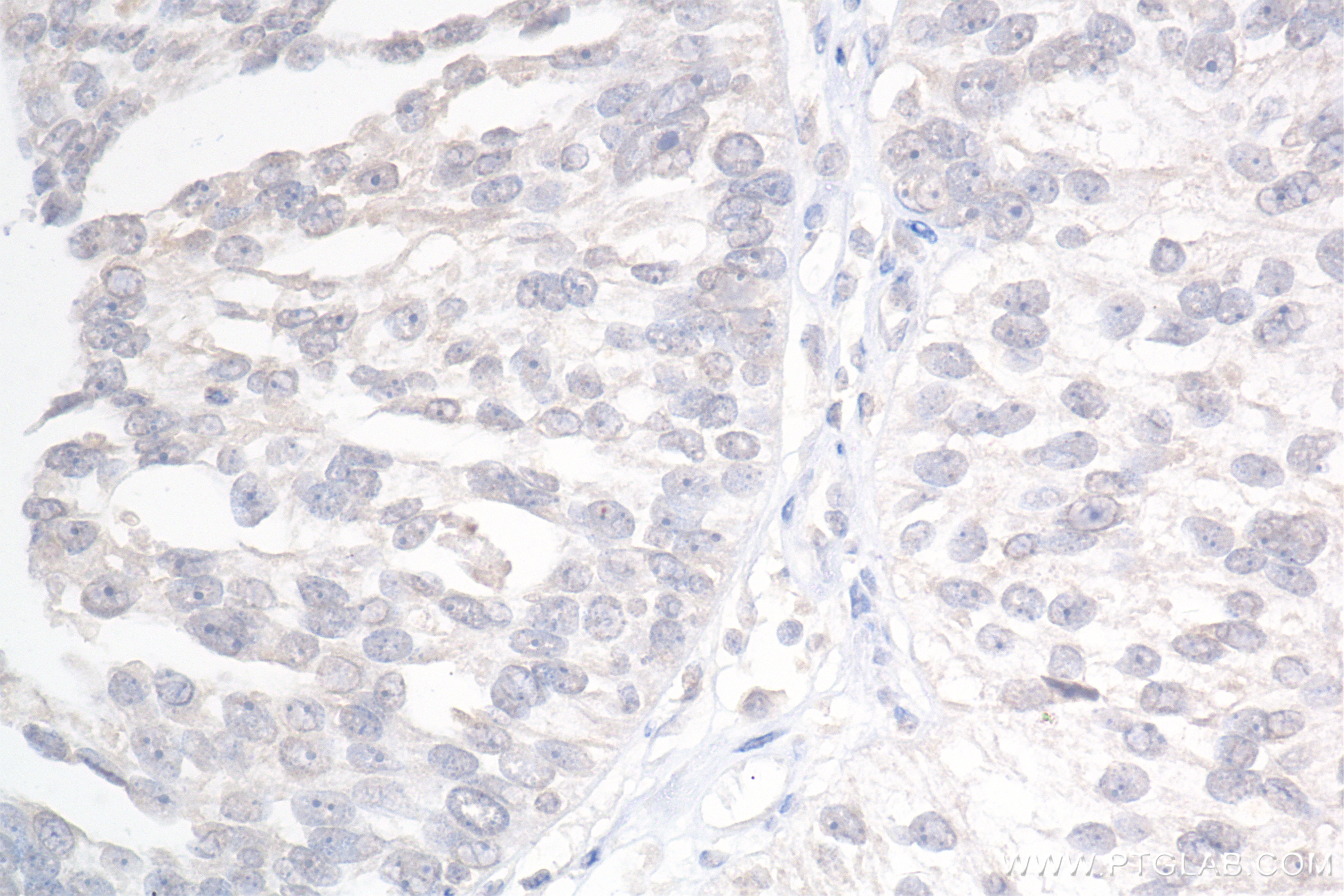 IHC staining of human ovary cancer using 85307-1-RR (same clone as 85307-1-PBS)