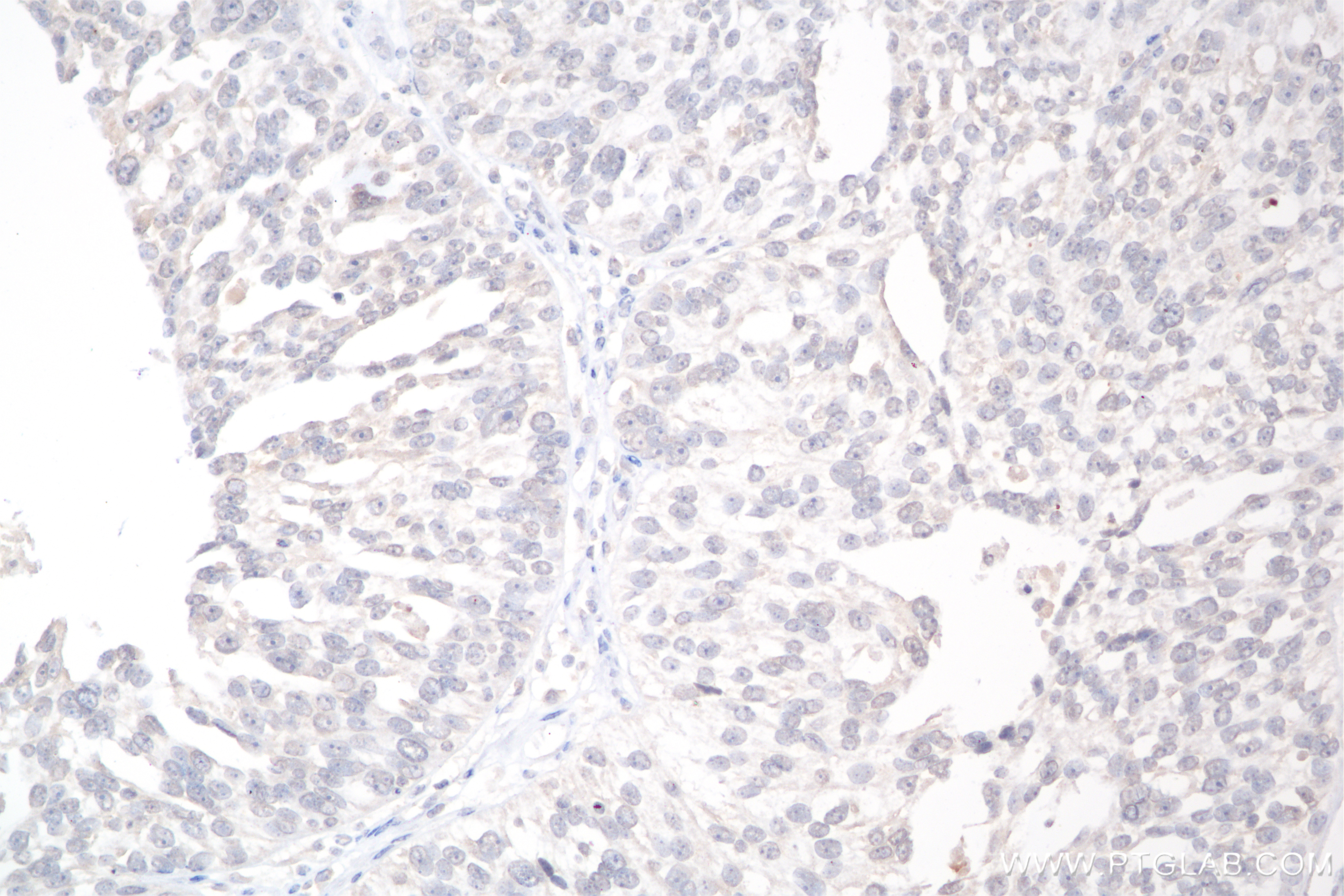 IHC staining of human ovary cancer using 85307-1-RR (same clone as 85307-1-PBS)