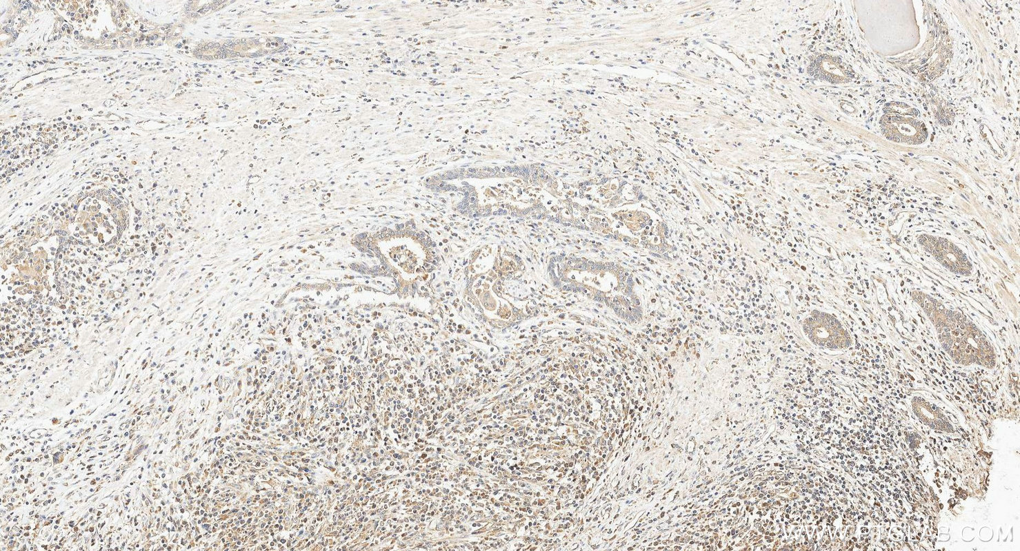 IHC staining of human prostate cancer using 10707-1-AP IHC staining of human prostate cancer using 10707-1-AP