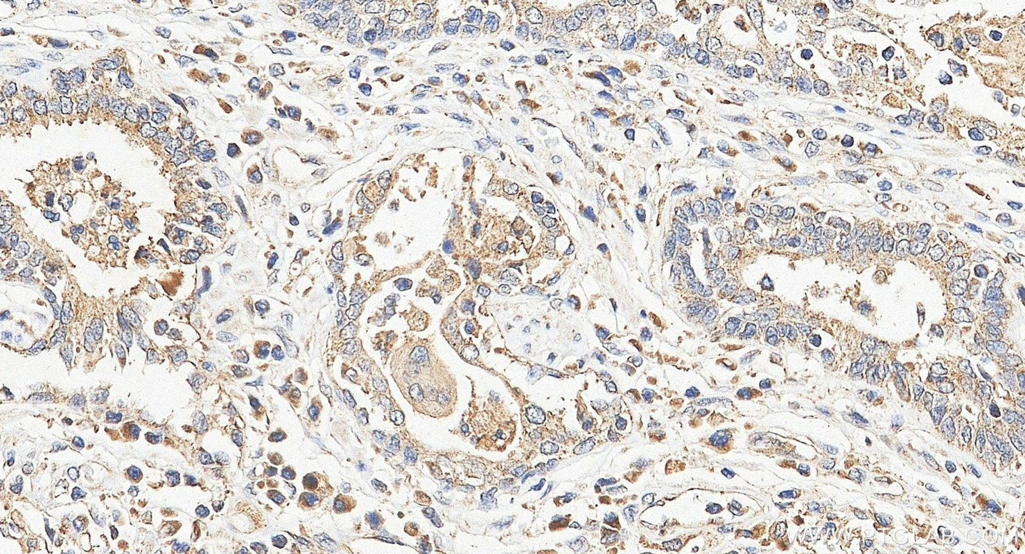 IHC staining of human prostate cancer using 10707-1-AP IHC staining of human prostate cancer using 10707-1-AP