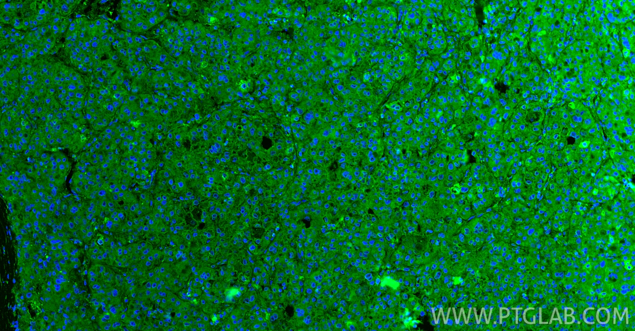 IF Staining of human liver cancer using 17402-1-AP