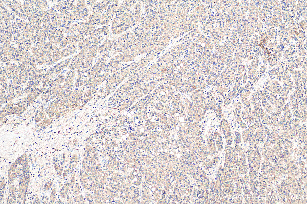 IHC staining of human liver cancer using 17402-1-AP