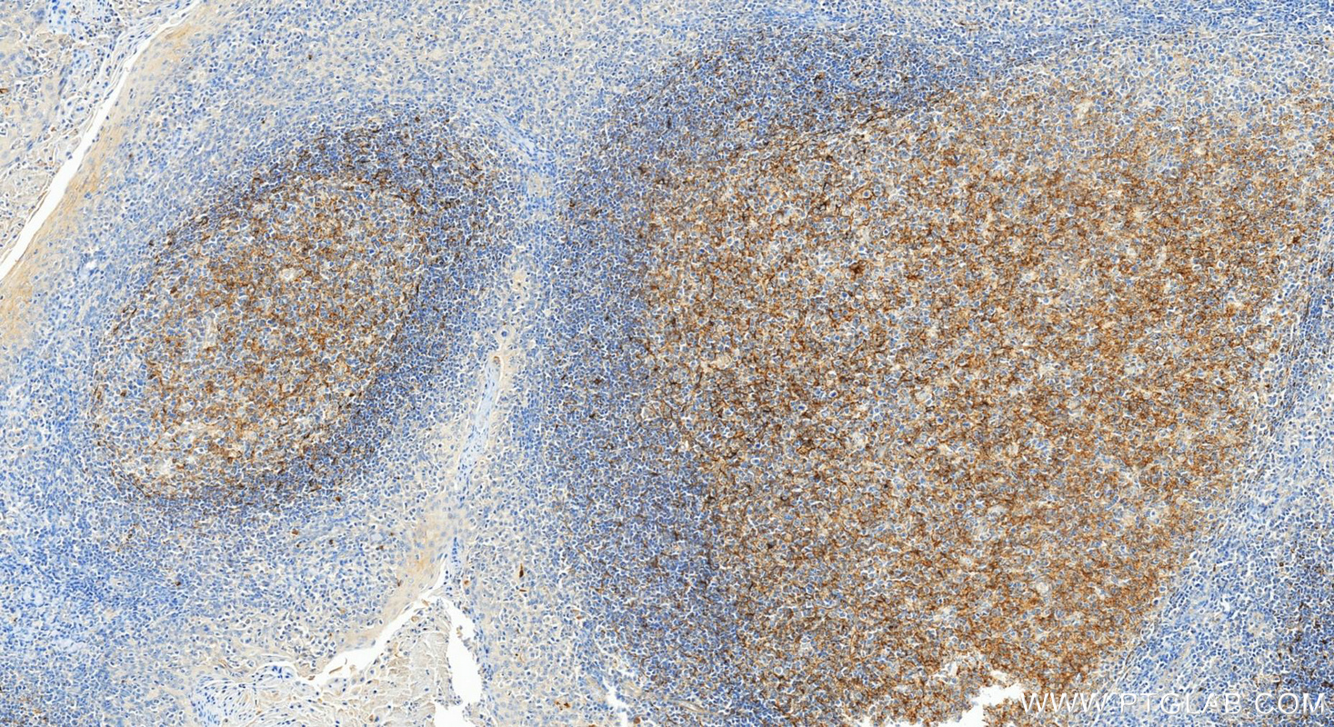 IHC staining of human tonsillitis using 10927-1-AP