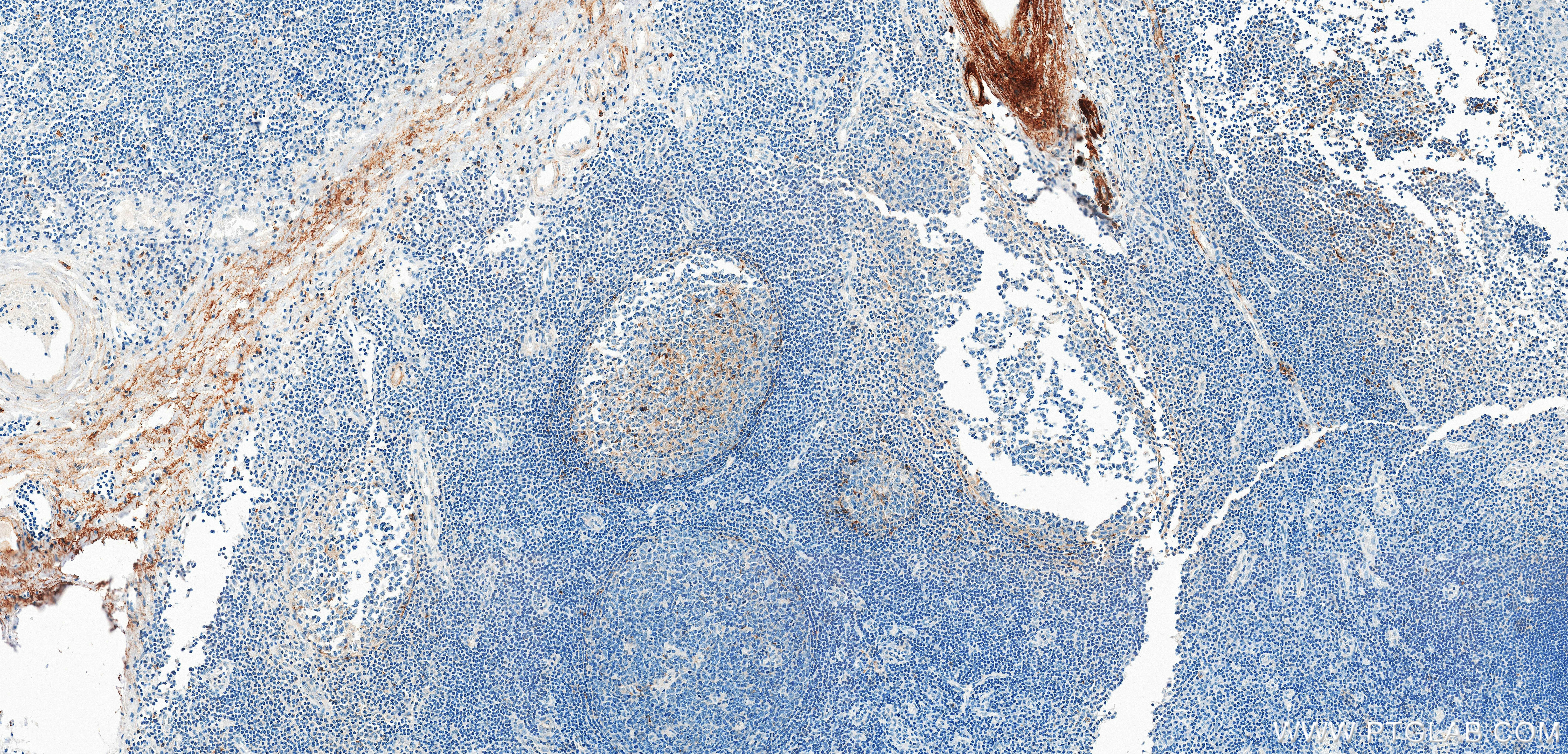 IHC staining of human tonsillitis using 87928-3-RR (same clone as 87928-3-PBS) IHC staining of human tonsillitis using 87928-3-RR (same clone as 87928-3-PBS)