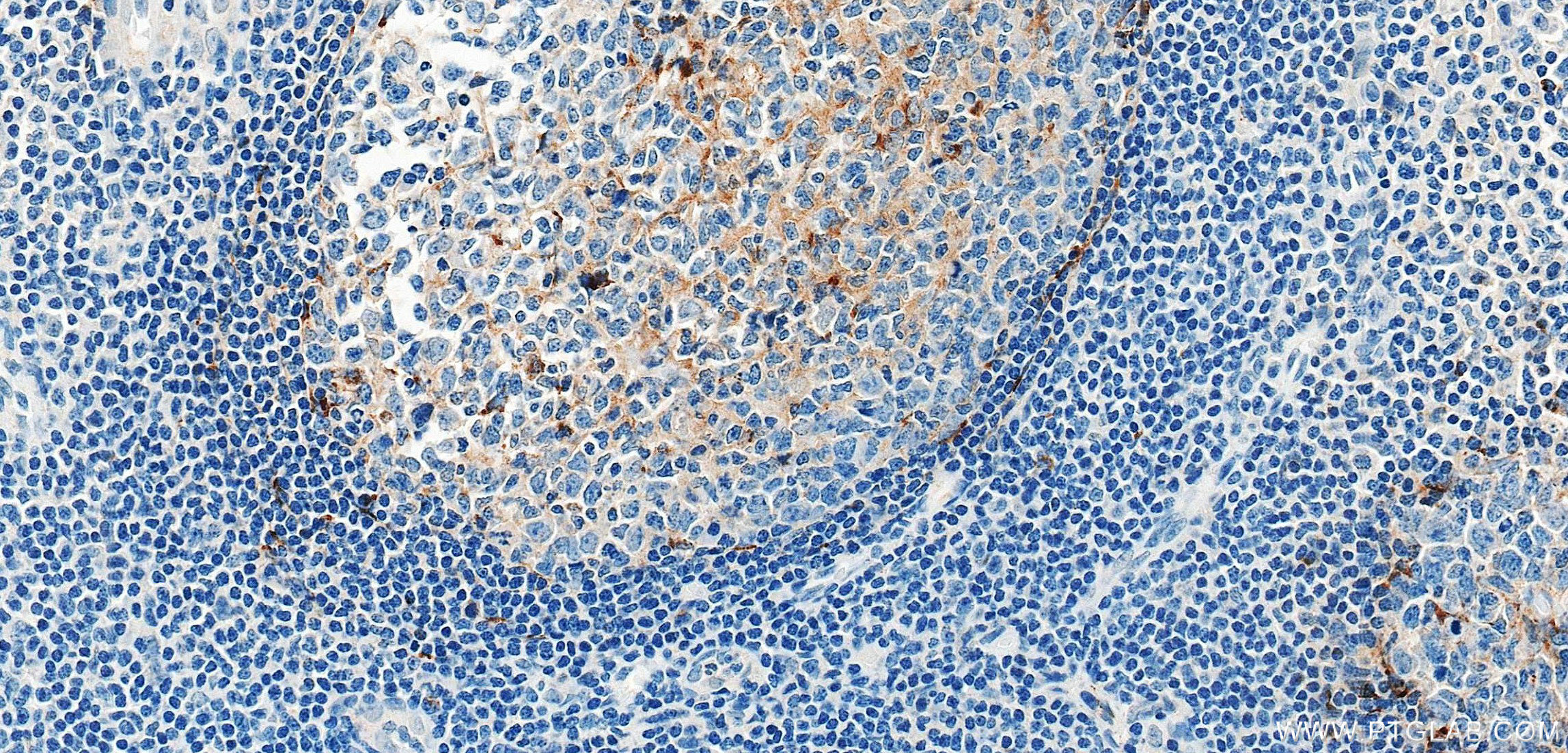 IHC staining of human tonsillitis using 87928-3-RR (same clone as 87928-3-PBS) IHC staining of human tonsillitis using 87928-3-RR (same clone as 87928-3-PBS)