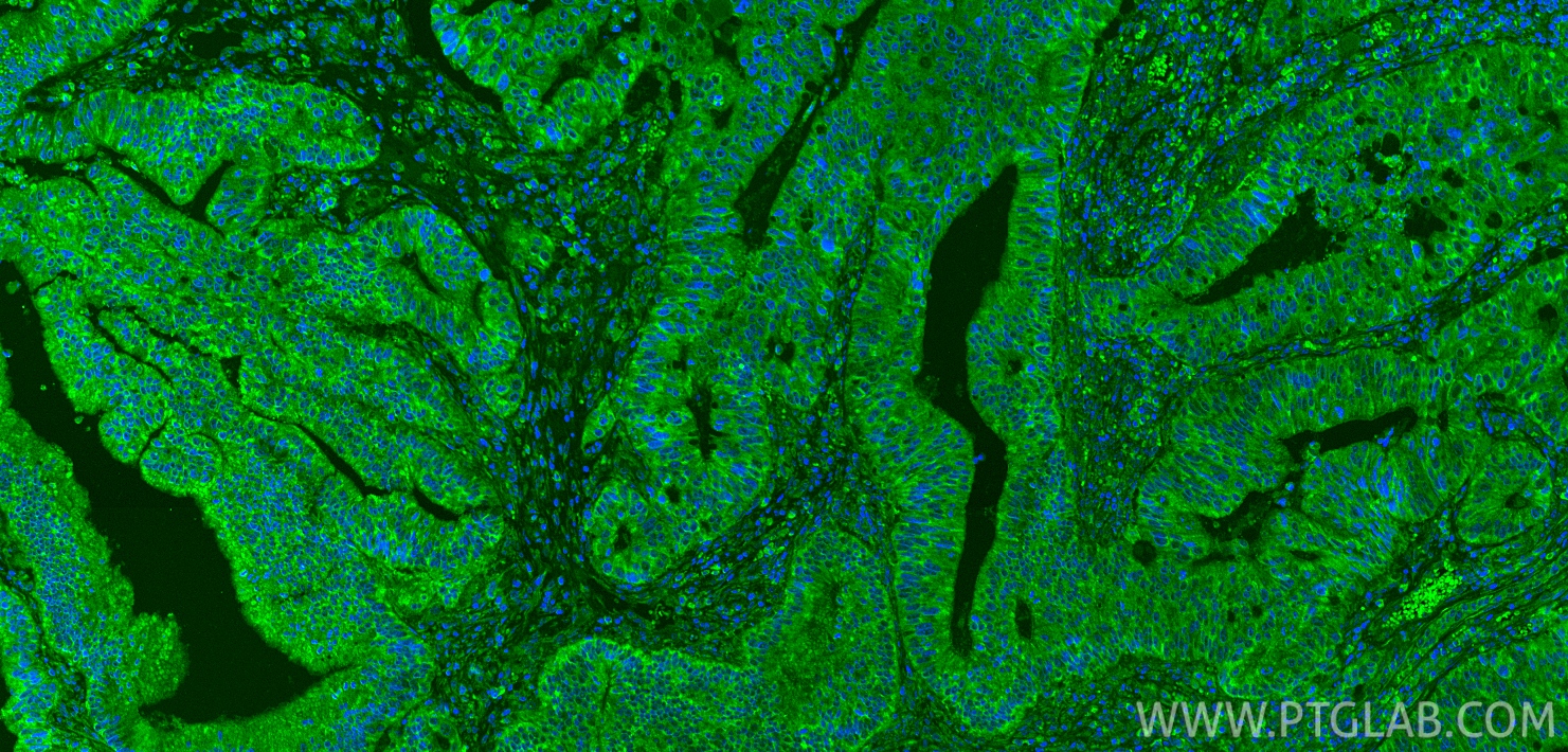 IF Staining of human colon cancer using 18108-1-AP IF Staining of human colon cancer using 18108-1-AP