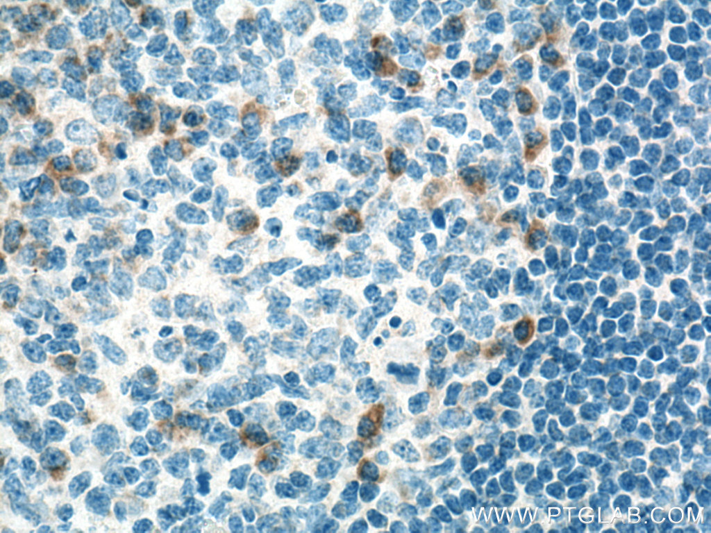 IHC staining of human tonsillitis using 17038-1-AP