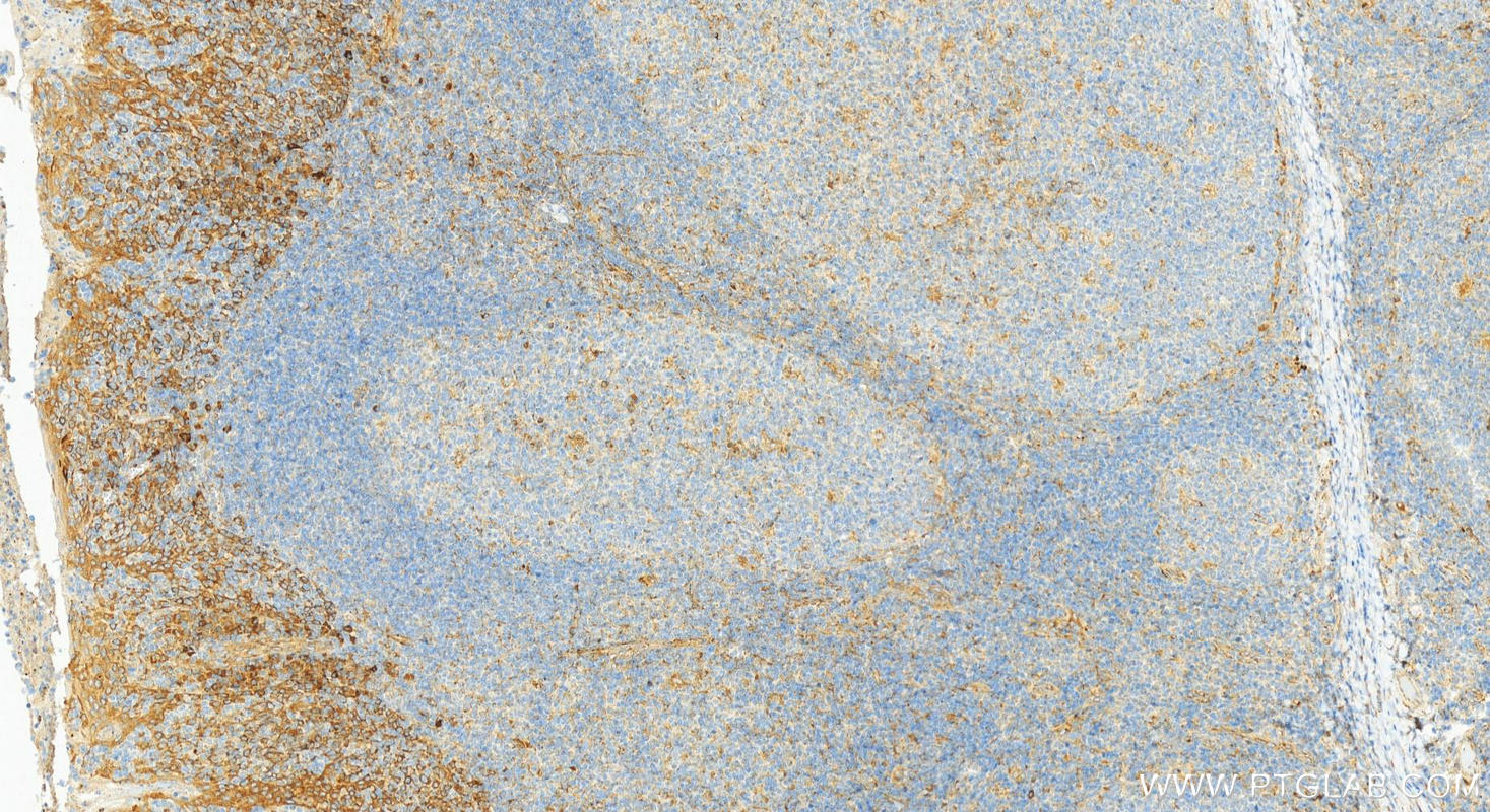 IHC staining of human tonsillitis using 31533-1-AP