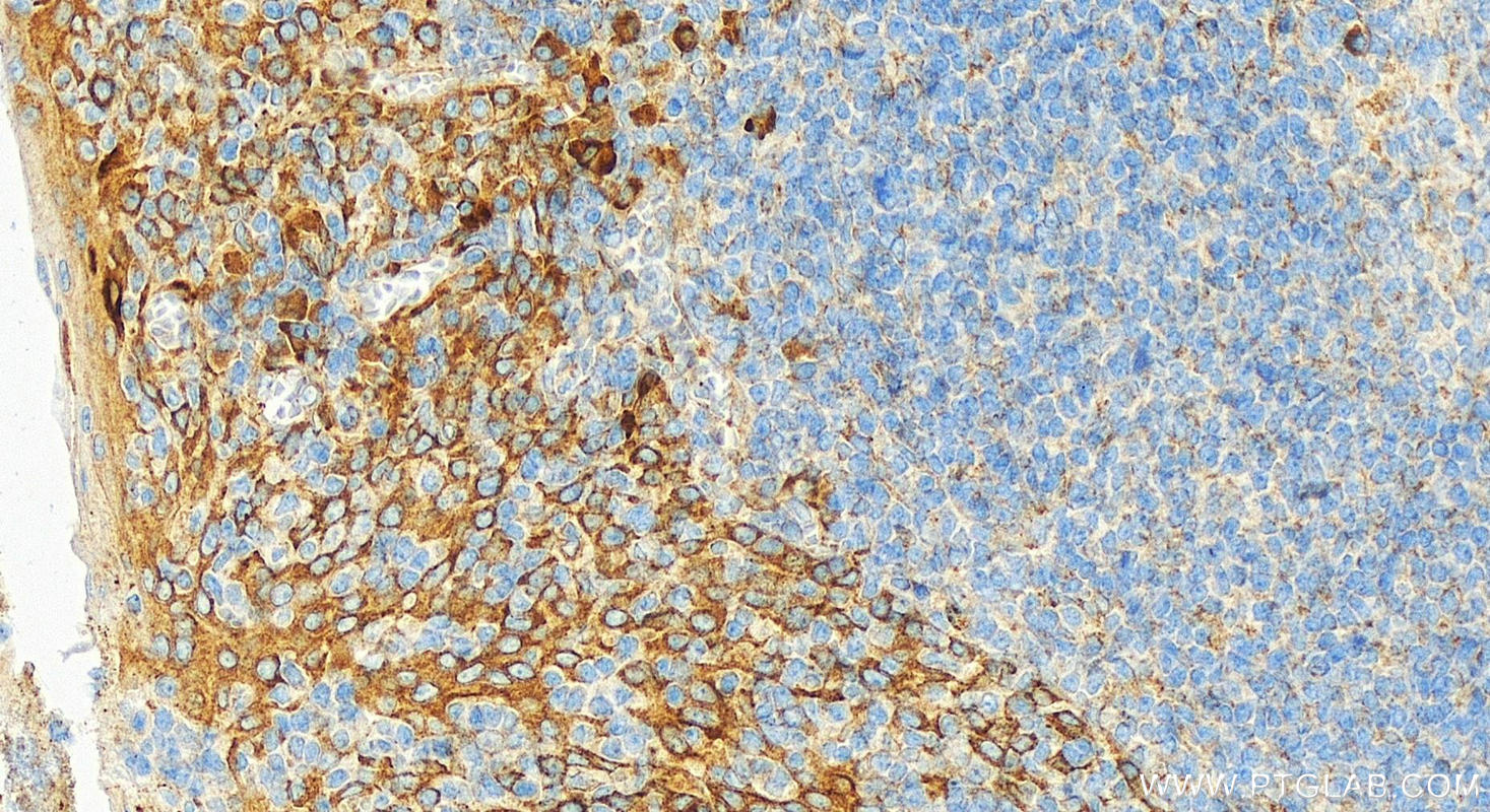 IHC staining of human tonsillitis using 31533-1-AP