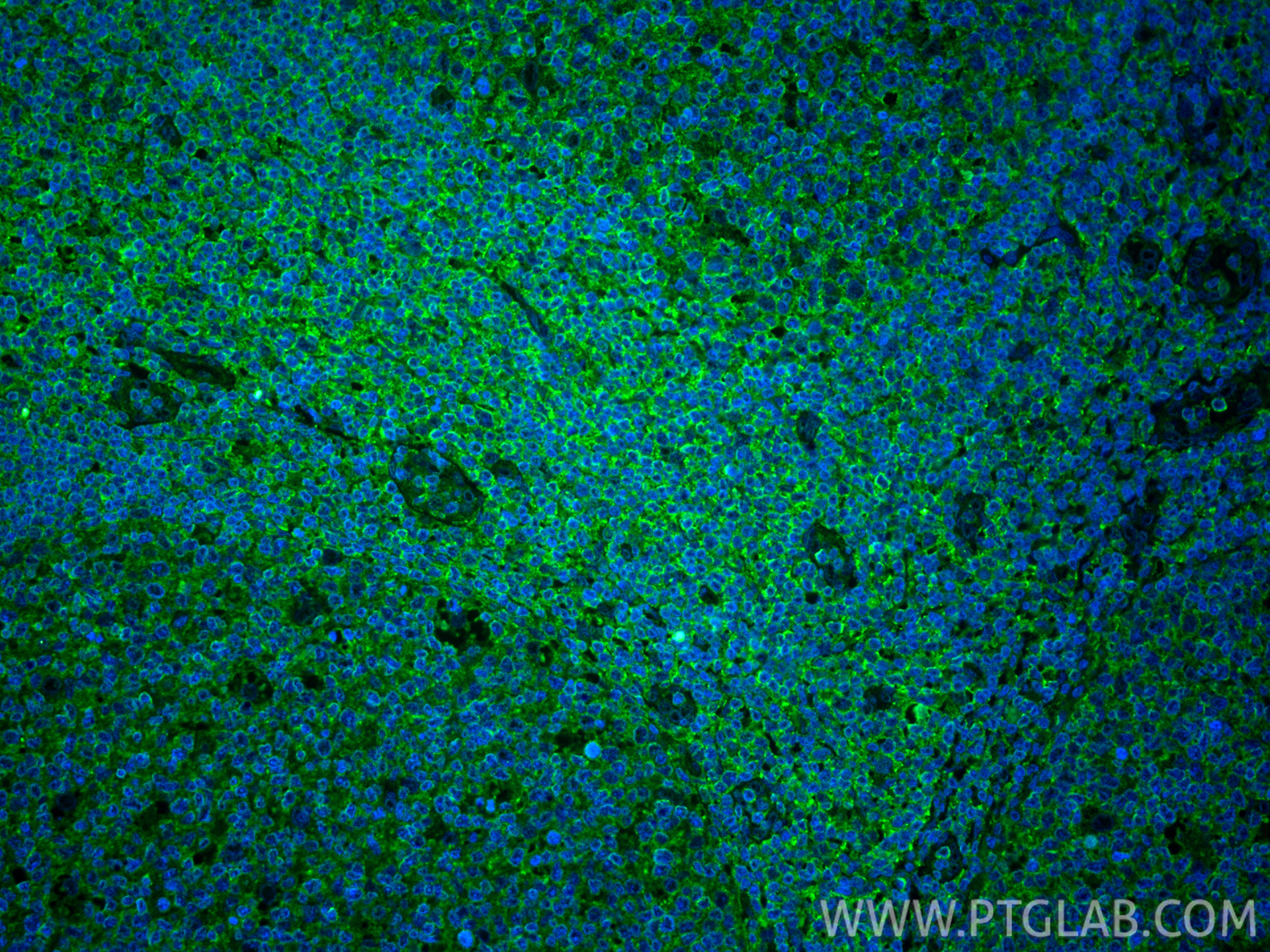 Immunofluorescent analysis of (4% PFA) fixed paraffin-embedded human tonsillitis tissue using CXCR3B-specific antibody (<a class='green' href='/productredirect?CatalogNo=60065-1-Ig' target='_blank'>60065-1-Ig</a>, Clone: 1B2D6 ) at dilution of 1:400 and CoraLite®488-Conjugated Goat Anti-Mouse IgG(H+L) (<a class='green' href='/productredirect?CatalogNo=SA00013-1' target='_blank'>SA00013-1</a>). Heat mediated antigen retrieval with Tris-EDTA buffer (pH 9.0). This data was developed using the same antibody clone with 60065-1-PBS in a different storage buffer formulation. IF Staining of human tonsillitis using 60065-1-Ig (same clone as 60065-1-PBS)