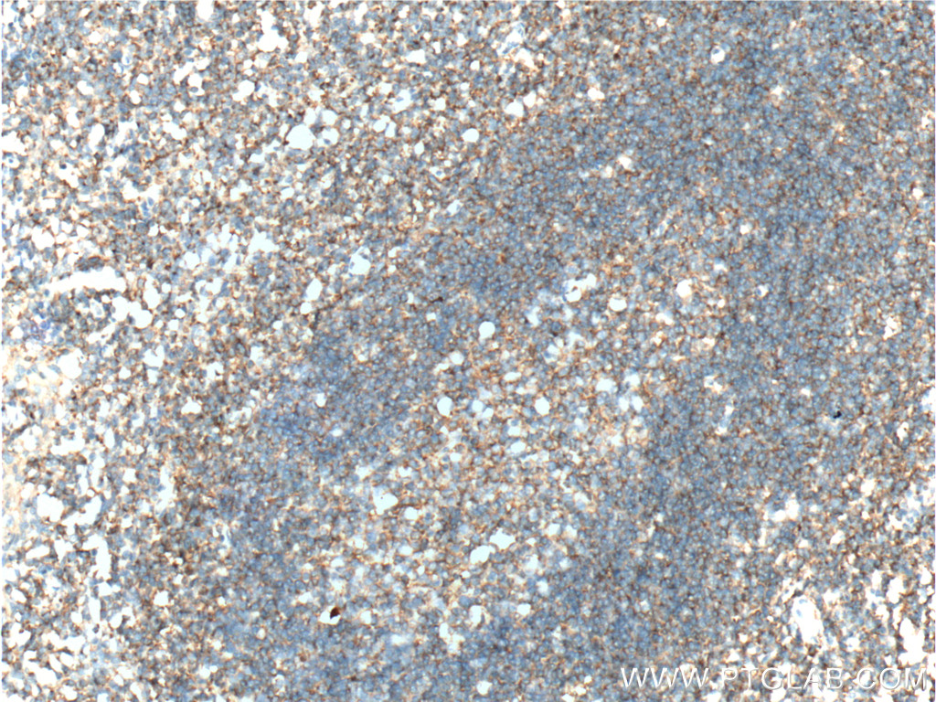 IHC staining of human tonsillitis using 60065-1-Ig (same clone as 60065-1-PBS)