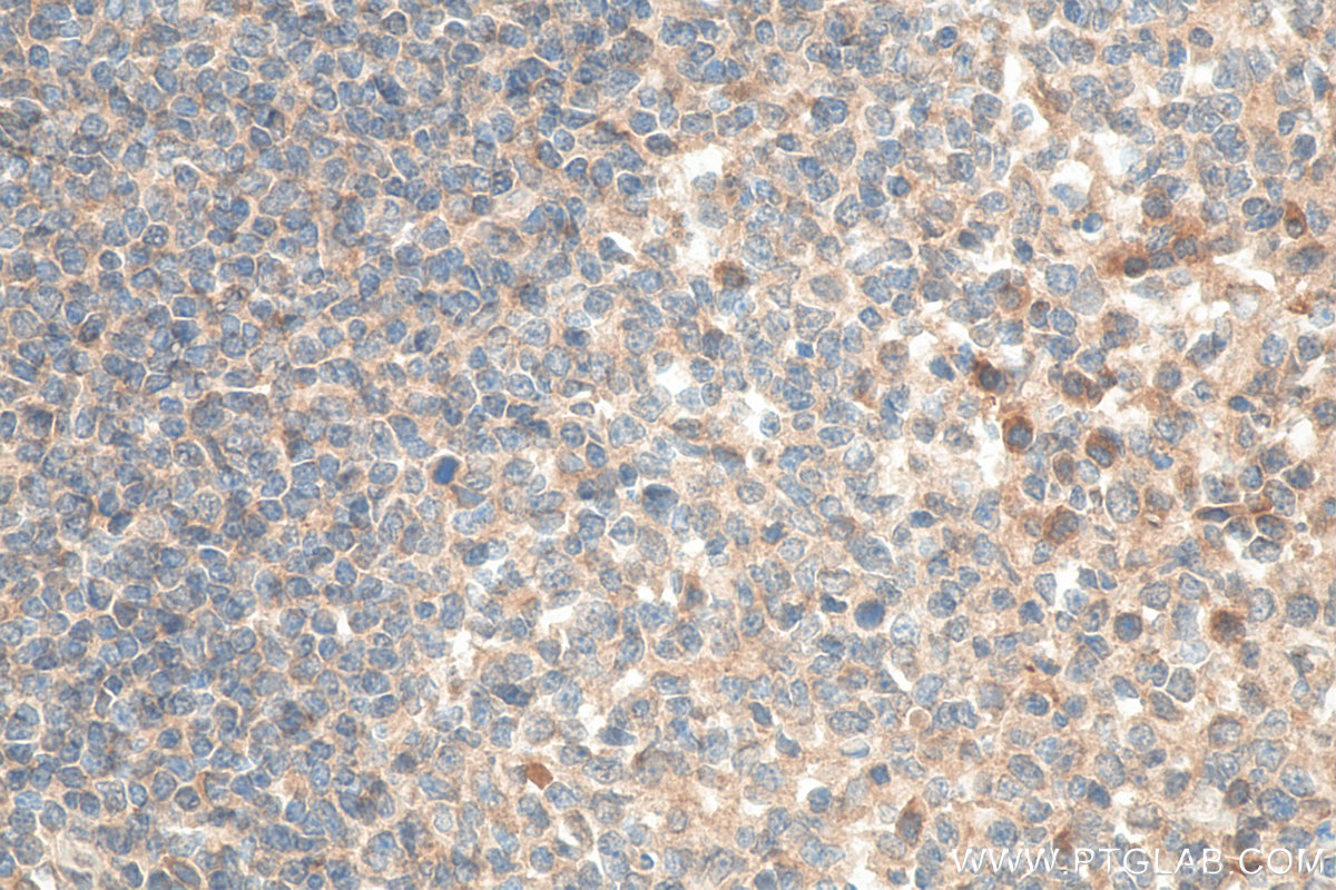 IHC staining of human tonsillitis using 11073-2-AP