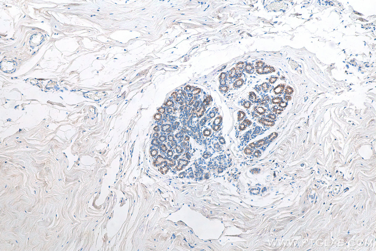 IHC staining of human breast cancer using Biotin-60042