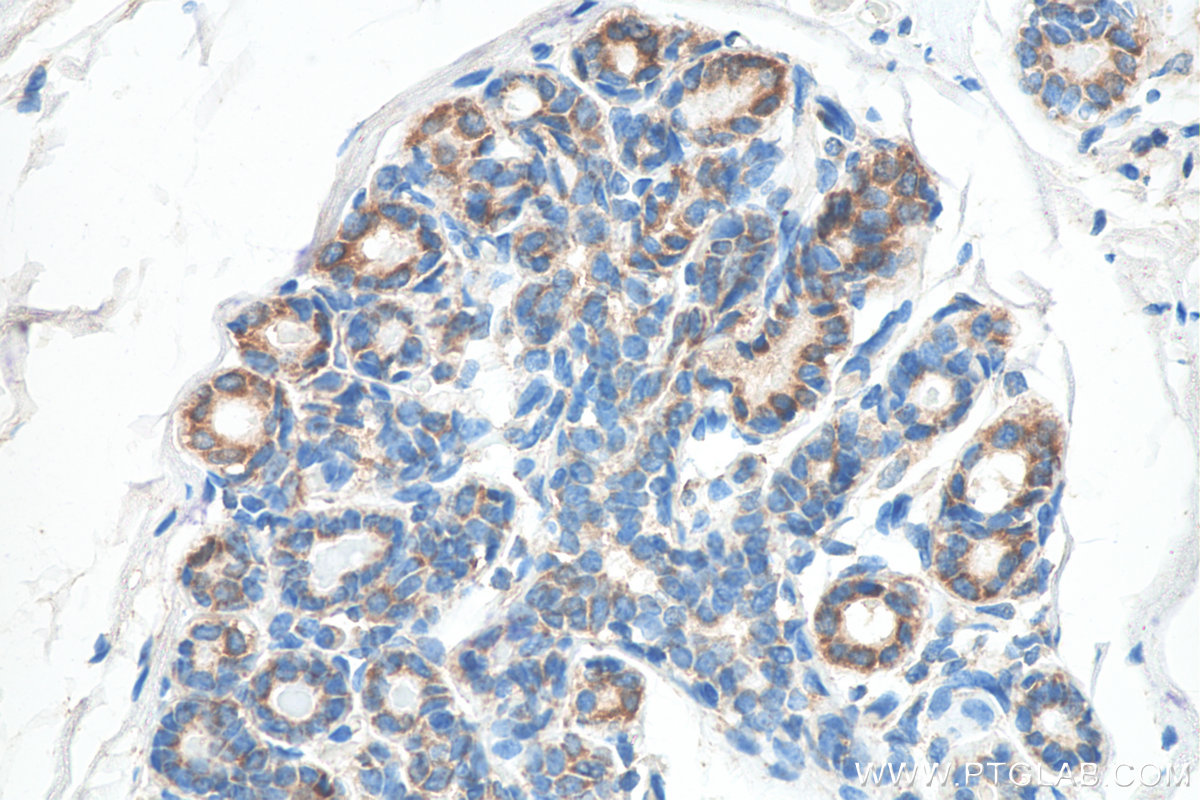 IHC staining of human breast cancer using Biotin-60042
