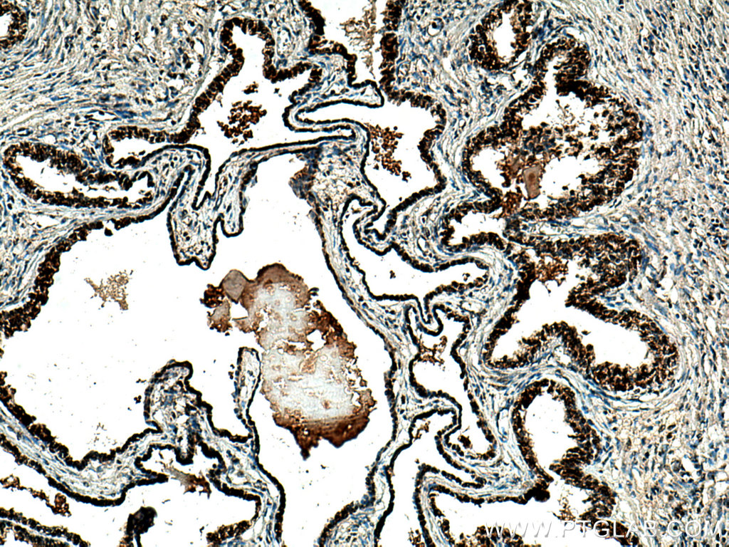 IHC staining of human prostate cancer using 16513-1-AP