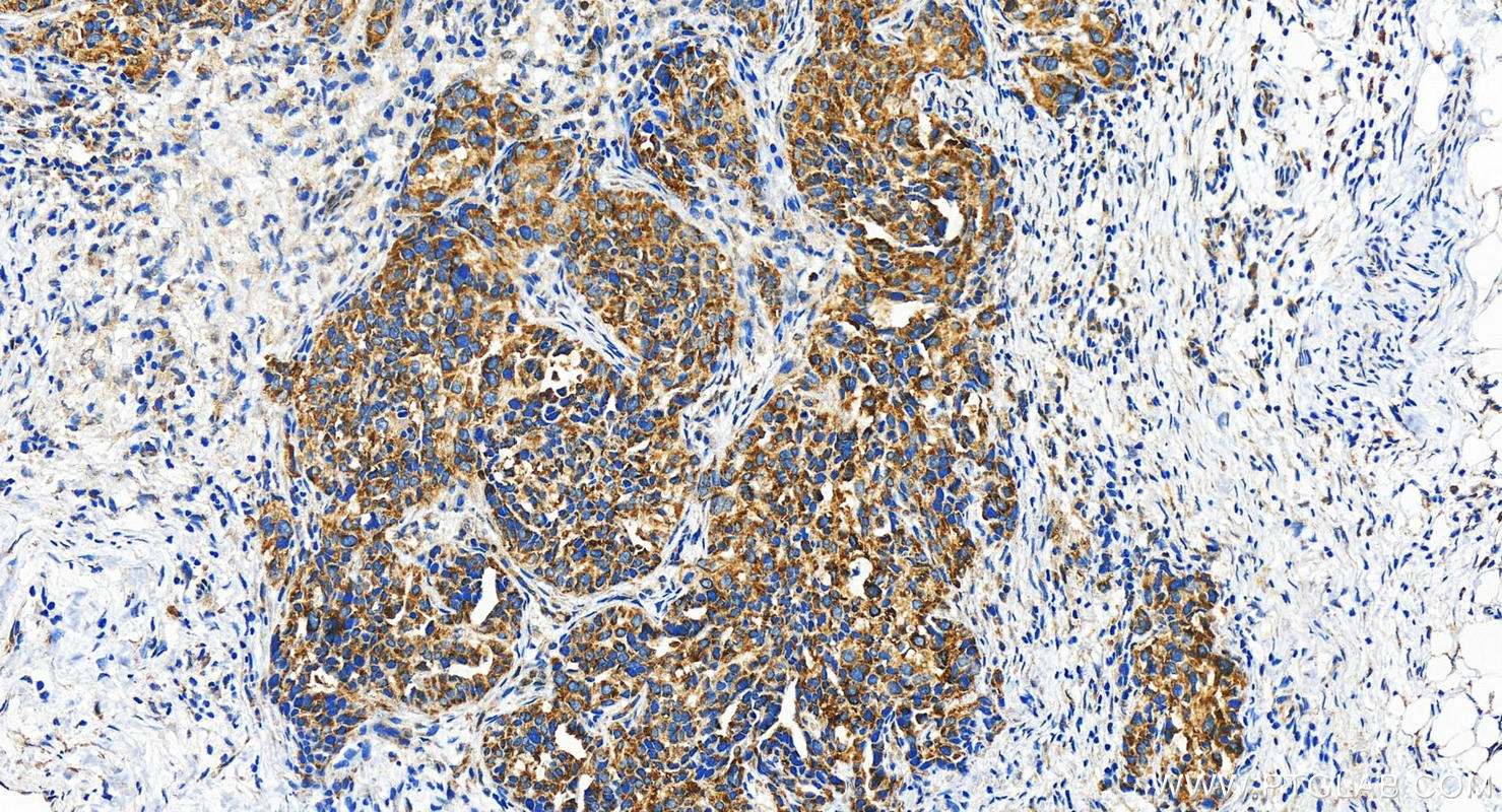 IHC staining of human ovary cancer using 22357-1-AP