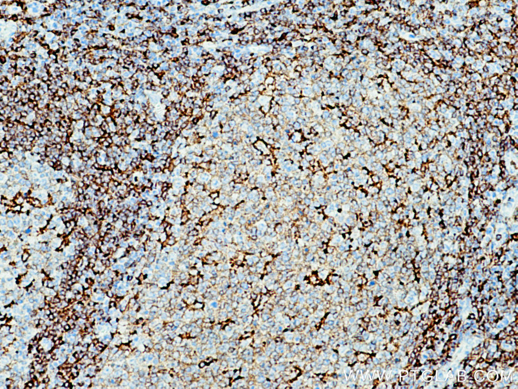 IHC staining of human tonsillitis using 19013-1-AP