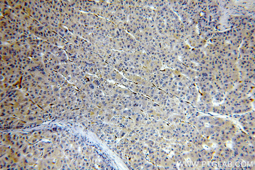 IHC staining of human liver cancer using 13317-1-AP