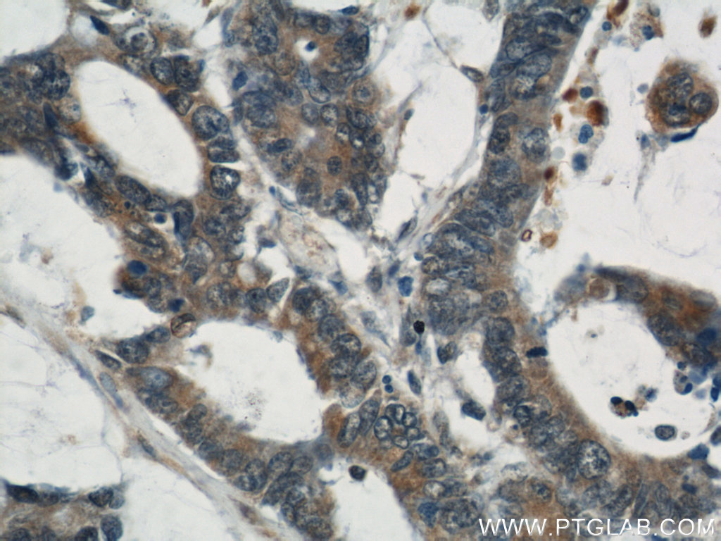IHC staining of human colon cancer using 11110-1-AP