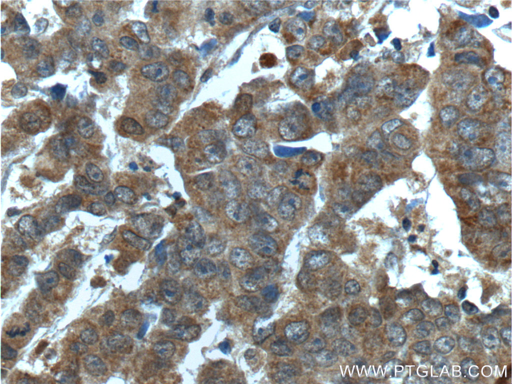 IHC staining of human prostate cancer using 14447-1-AP