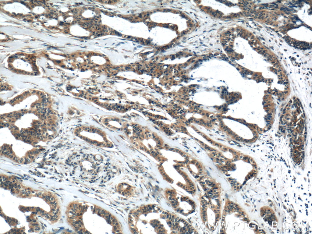 IHC staining of human breast cancer using 13241-1-AP