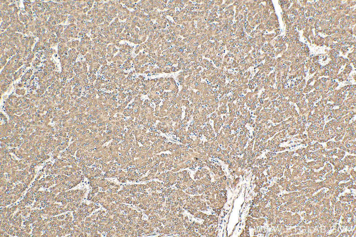 Immunohistochemical analysis of paraffin-embedded human liver cancer tissue slide using 13241-1-AP (CYP1A1 antibody) at dilution of 1:200 (under 10x lens). Heat mediated antigen retrieval with Tris-EDTA buffer (pH 9.0). IHC staining of human liver cancer using 13241-1-AP