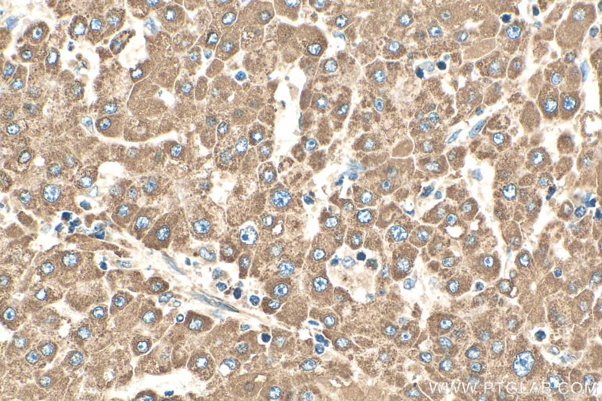 Immunohistochemical analysis of paraffin-embedded human liver cancer tissue slide using 13241-1-AP (CYP1A1 antibody) at dilution of 1:200 (under 40x lens). Heat mediated antigen retrieval with Tris-EDTA buffer (pH 9.0). IHC staining of human liver cancer using 13241-1-AP