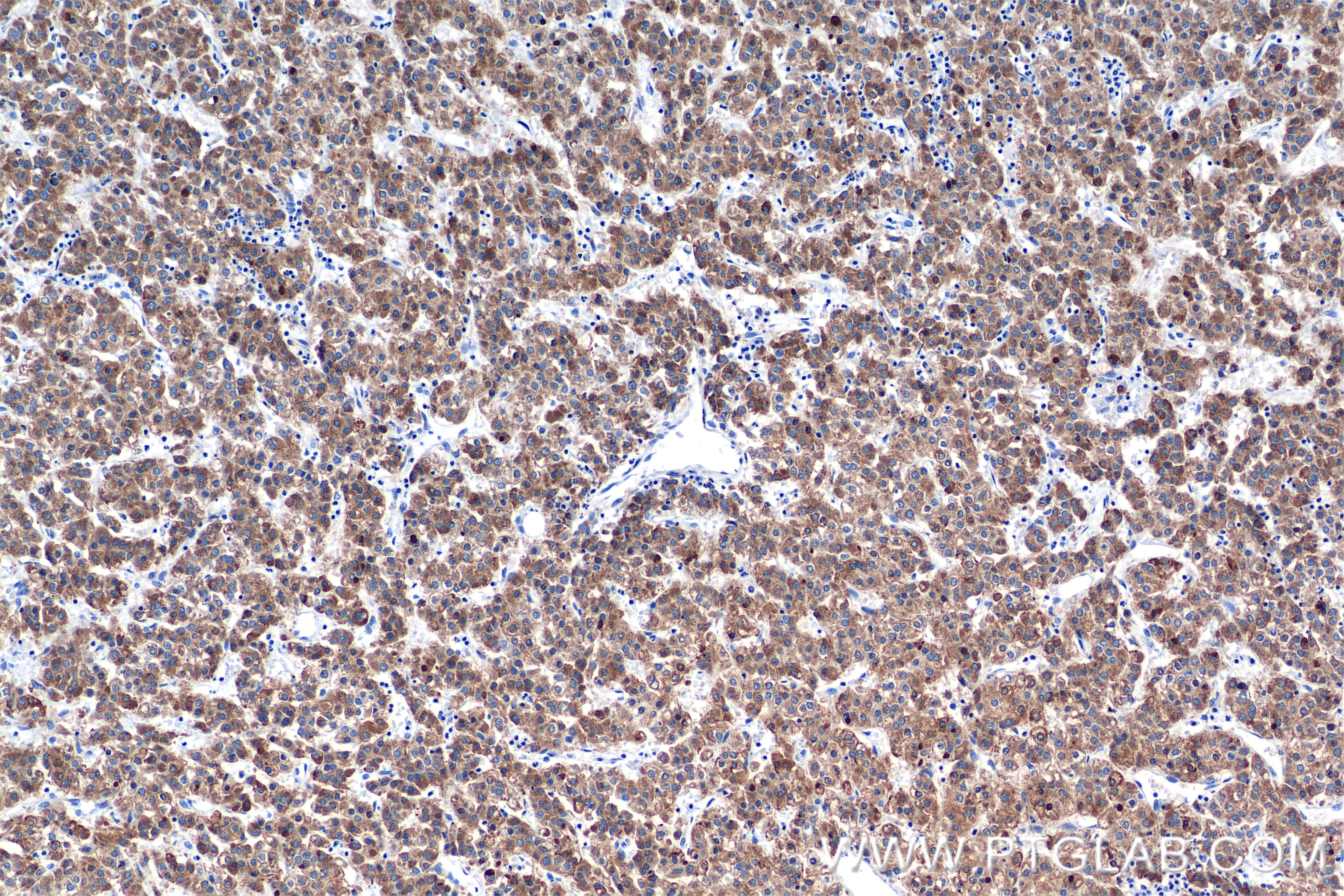 Immunohistochemical analysis of paraffin-embedded Human Hepatocellular cancer tissue slide using 84751-1-RR (CYP1A2-Specific antibody) at dilution of 1:400 (under 10x lens). Heat mediated antigen retrieval with Tris-EDTA buffer (pH 9.0). IHC staining of Human Hepatocellular cancer using 84751-1-RR