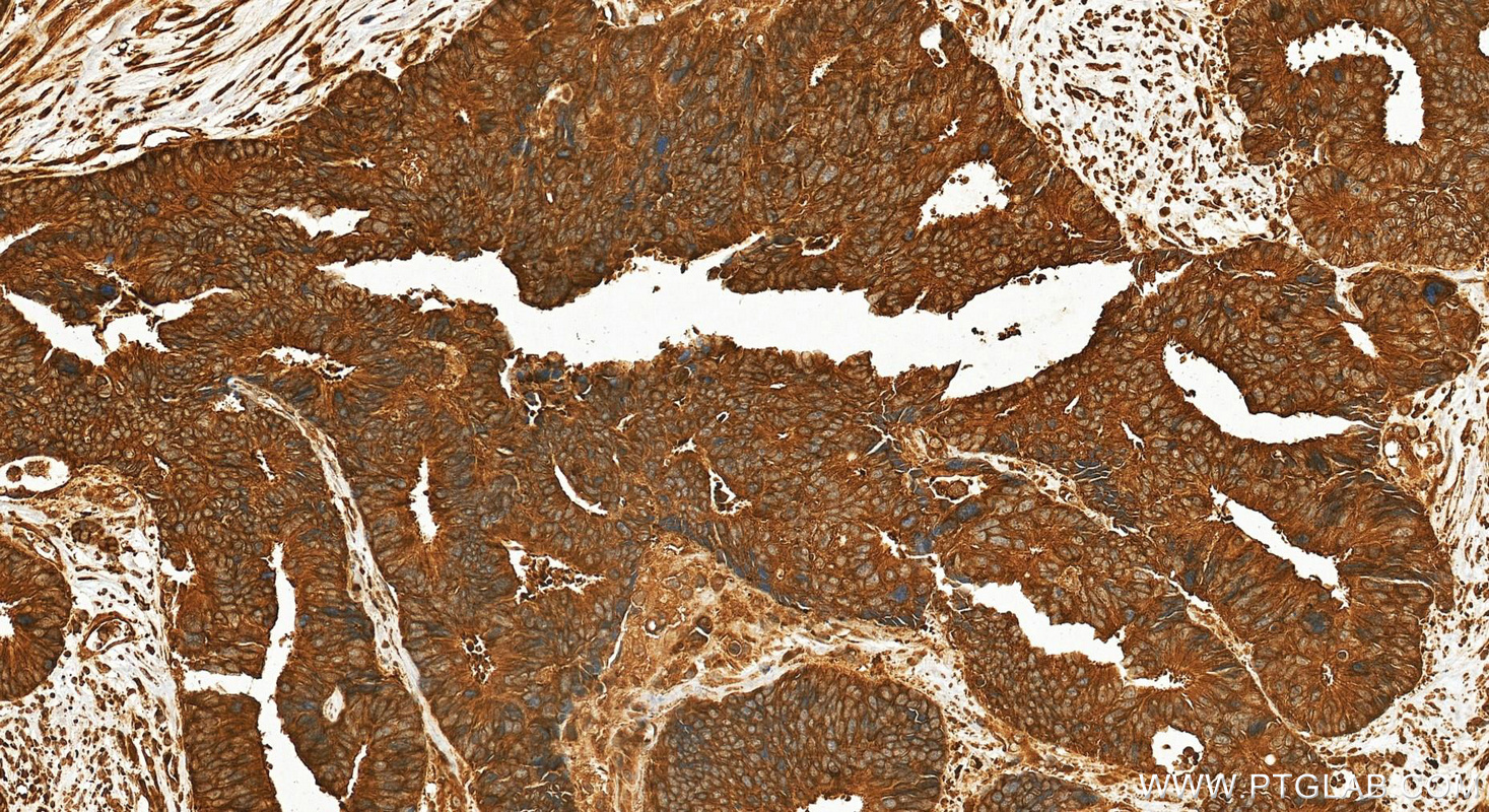 Immunohistochemical analysis of paraffin-embedded human colon cancer tissue slide using 18505-1-AP (CYP1B1 antibody) at dilution of 1:200 (under 20x lens). Heat mediated antigen retrieval with Tris-EDTA buffer (pH 9.0). IHC staining of human colon cancer using 18505-1-AP