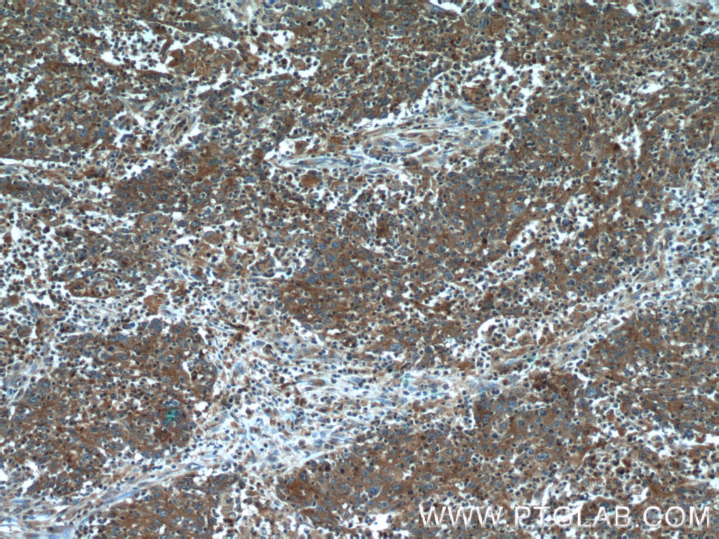 IHC staining of human colon cancer using 18505-1-AP