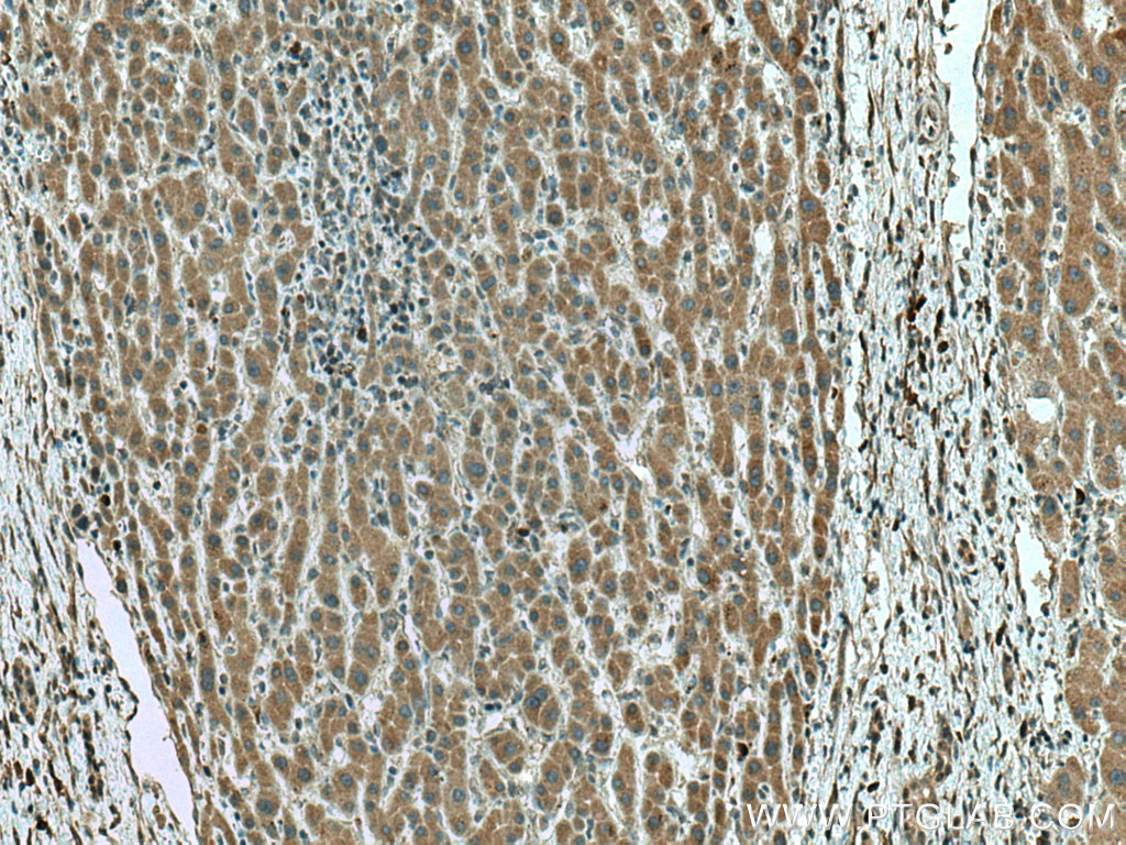 IHC staining of human liver cancer using 67433-1-Ig (same clone as 67433-1-PBS)