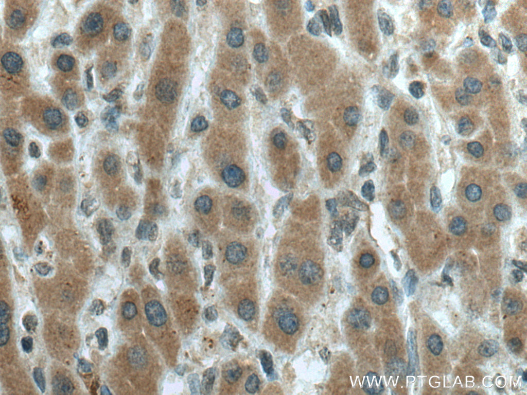 IHC staining of human liver cancer using 67433-1-Ig (same clone as 67433-1-PBS)